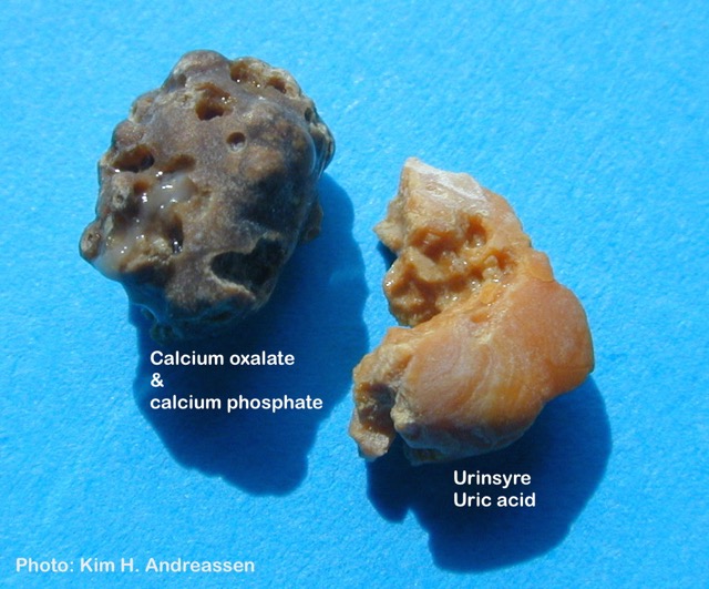 Nyresten (CaOx-CaPh og urinsyre) fjernet ved RIRS