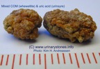 027b-kidney-stone-nyresten-COM+UricAcid-urinsyre-spontan-Kim-Hovgaard-Andreassen