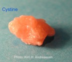031-kidney-stone-nyresten-cystine-RIRS-Kim-Hovgaard-Andreassen