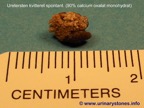 049da-kidney-stone-nyresten-COM-spontan-Kim-Hovgaard-Andreassen