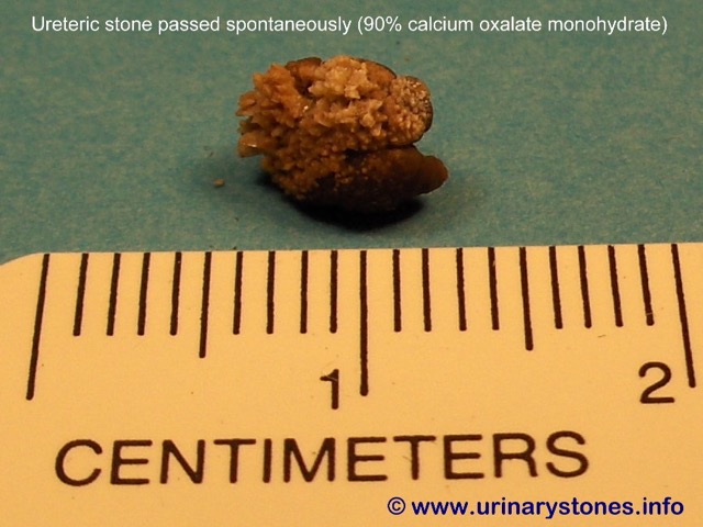 Kidney stone (calcium oxalate) spontaneous