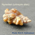 087-Kidney-stone-nyresten-UricAcid-urinsyre-URSL-Kim-Hovgaard-Andreassen