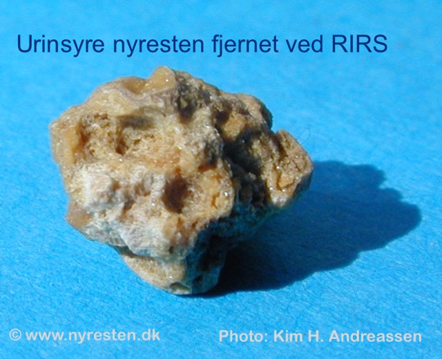 Nyresten (urinsyre) fra RIRS