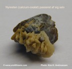 117b-kidney-stone_nyresten-calciumoxalate-spontan-Kim-Hovgaard-Andreassen