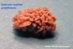013-kidney-stone_nyresten-calciumoxalate-spontan-Kim-Hovgaard-Andreassen