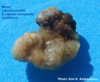 019-kidney-stone_nyresten-calcium-oxalate-phosphate-Kim-Hovgaard-Andreassen