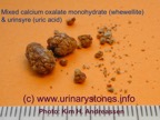 027a-kidney-stone-nyresten-COM+UricAcid-urinsyre-spontan-Kim-Hovgaard-Andreassen