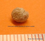 028-kidney-stone-nyresten-Apatite-CaOx-spontan-Kim-Hovgaard-Andreassen