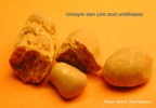 057b-kidney-stone-nyresten-UricAcid-urinsyre-spontan-Kim-Hovgaard-Andreassen