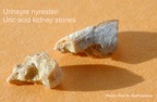 069-kidney-stone-nyresten-UricAcid-urinsyre-RIRS-Kim-Hovgaard-Andreassen