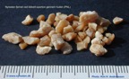 090-Kidney-stone-nyresten-PCNL-Kim-Hovgaard-Andreasssen