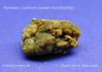 114-kidney-stone-nyresten-COM-Kim-Hovgaard-Andreassen